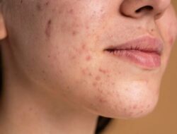 5 Urutan Skincare untuk Kulit Berjerawat Sesuai Saran Dokter Kulit